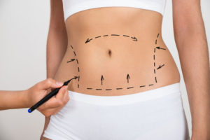 liposuction in India