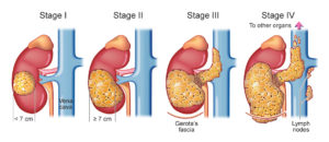 kidney cancer treatment in India