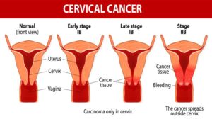 cervical cancer treatment in India