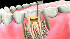 root canal treatment in India
